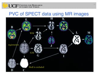 PVC of SPECT data using MR images
99
WM
GM
Skull is excluded
registration
 