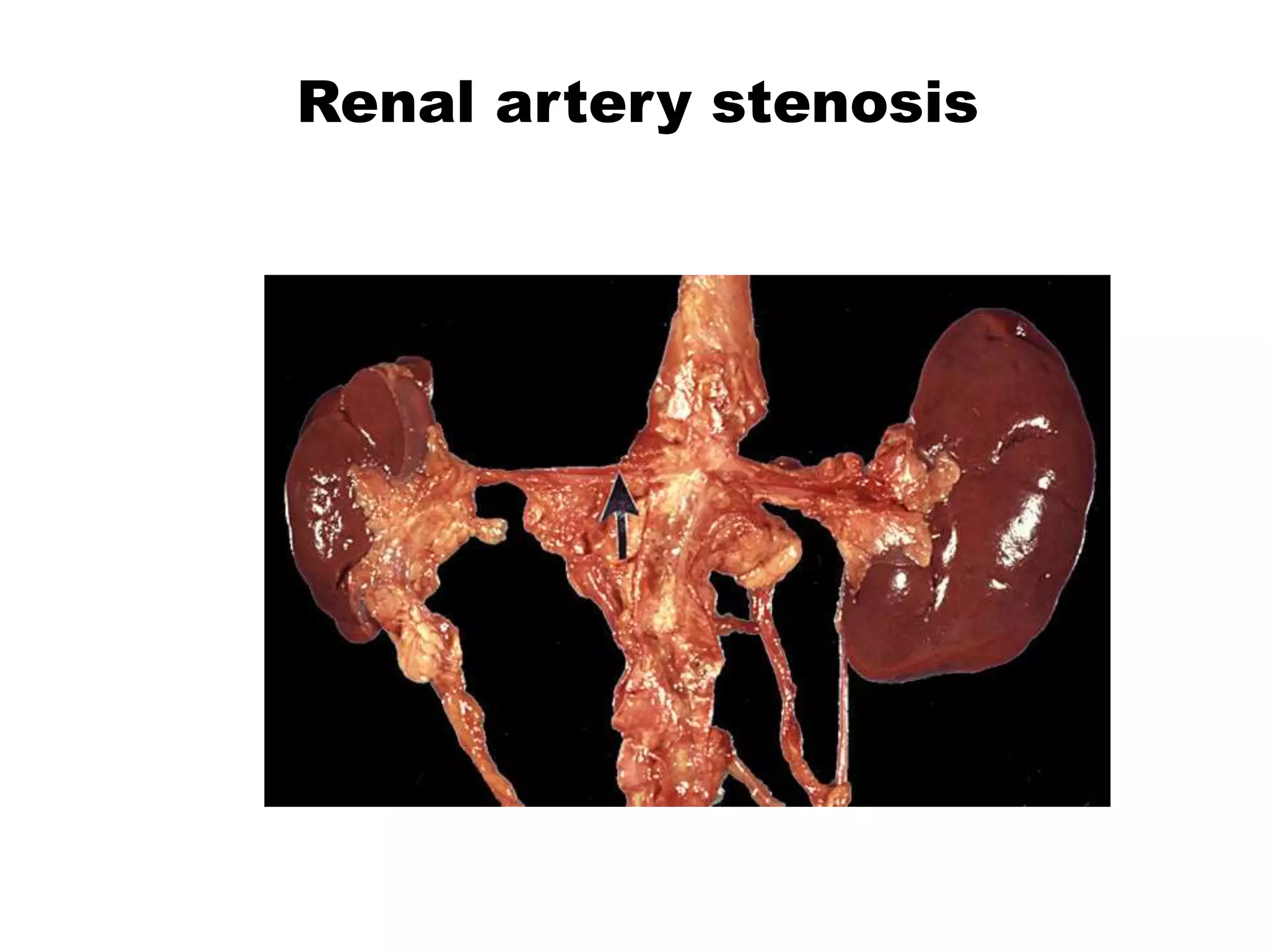 Renal artery stenosis
 