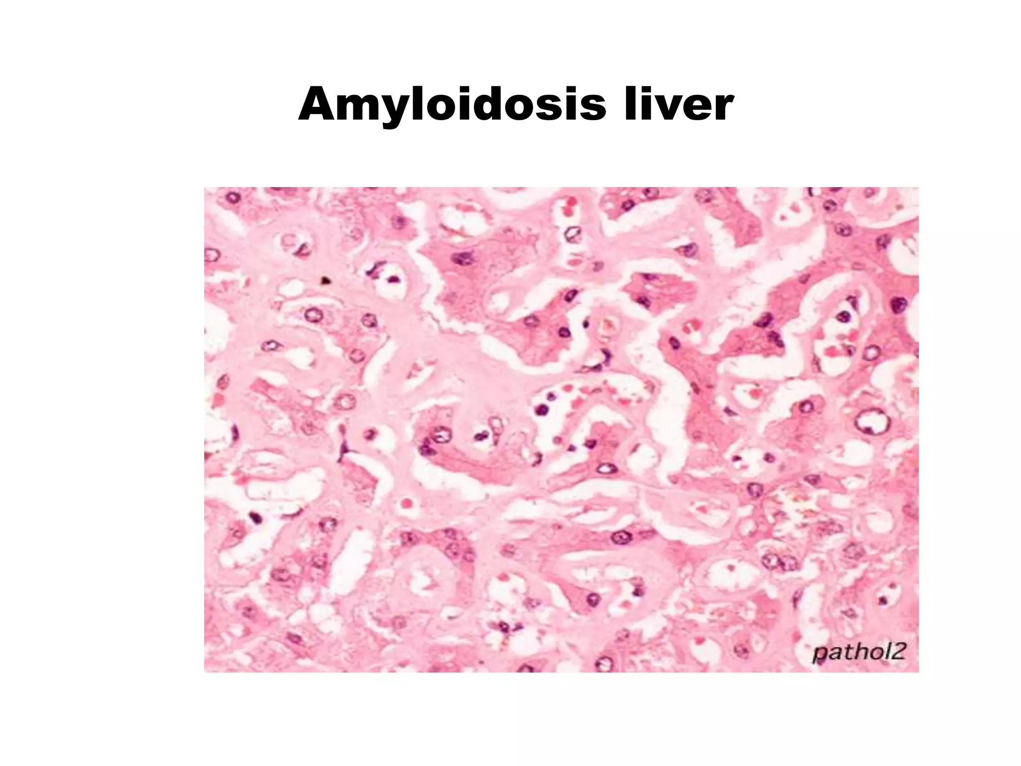 Amyloidosis liver
 
