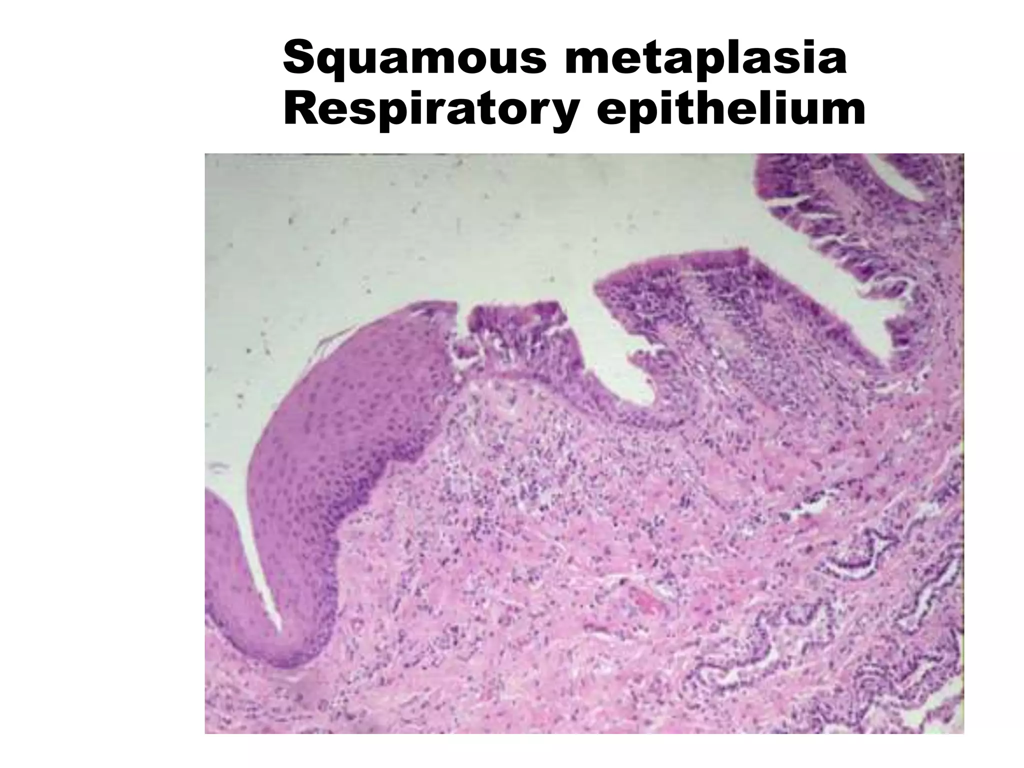 Squamous metaplasia
Respiratory epithelium
 