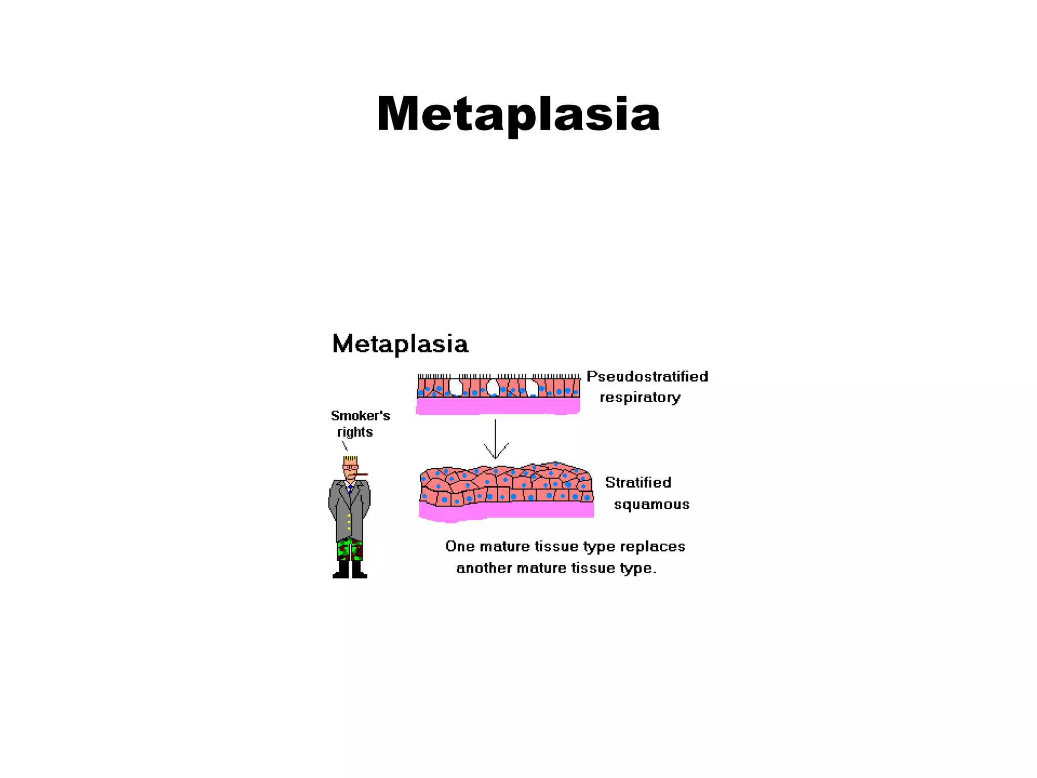 Metaplasia
 