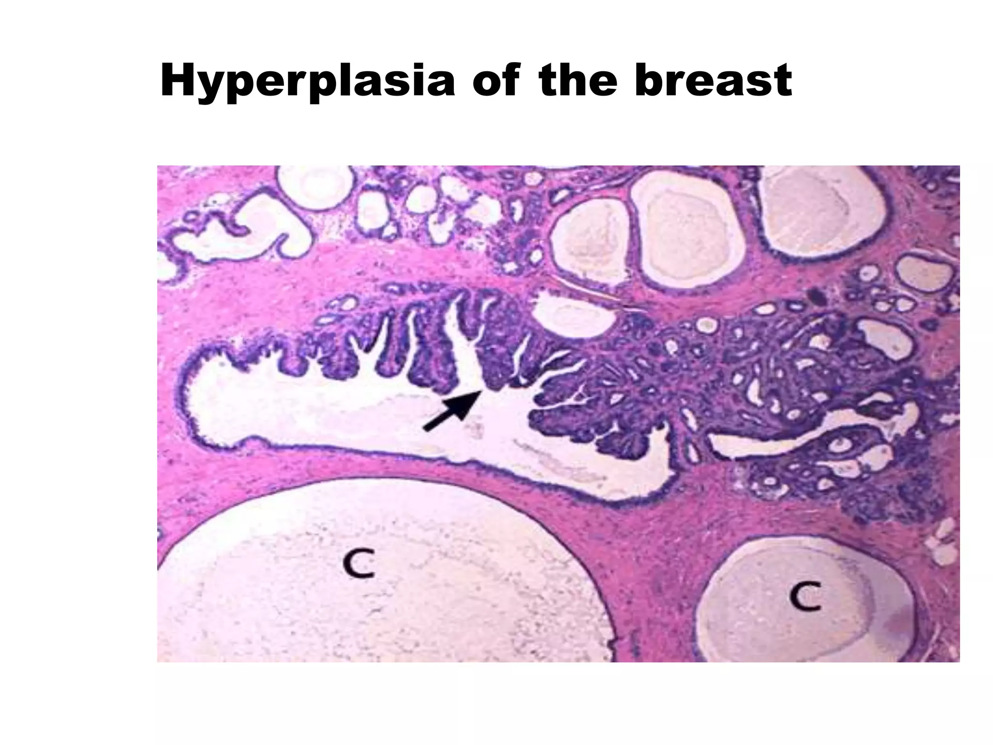 Hyperplasia of the breast
 