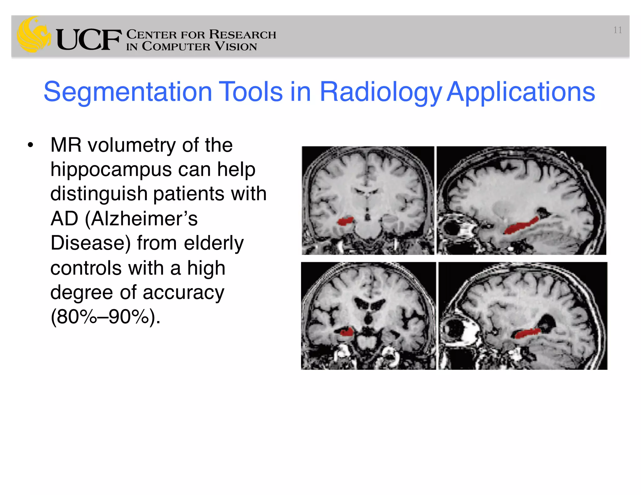 Segmentation Tools in RadiologyApplications
• MR volumetry of the
hippocampus can help
distinguish patients with
AD (Alzheimer’s
Disease) from elderly
controls with a high
degree of accuracy
(80%–90%).
11
 