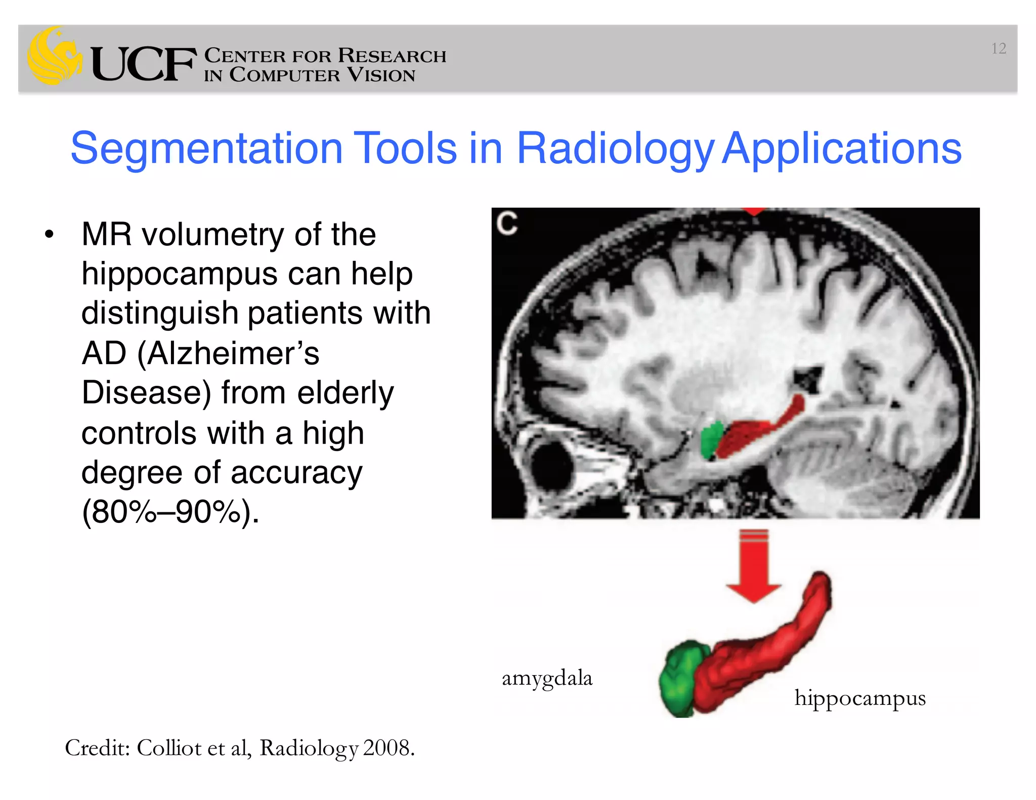 Segmentation Tools in RadiologyApplications
• MR volumetry of the
hippocampus can help
distinguish patients with
AD (Alzheimer’s
Disease) from elderly
controls with a high
degree of accuracy
(80%–90%).
12
hippocampus
amygdala
Credit: Colliot et al, Radiology 2008.
 