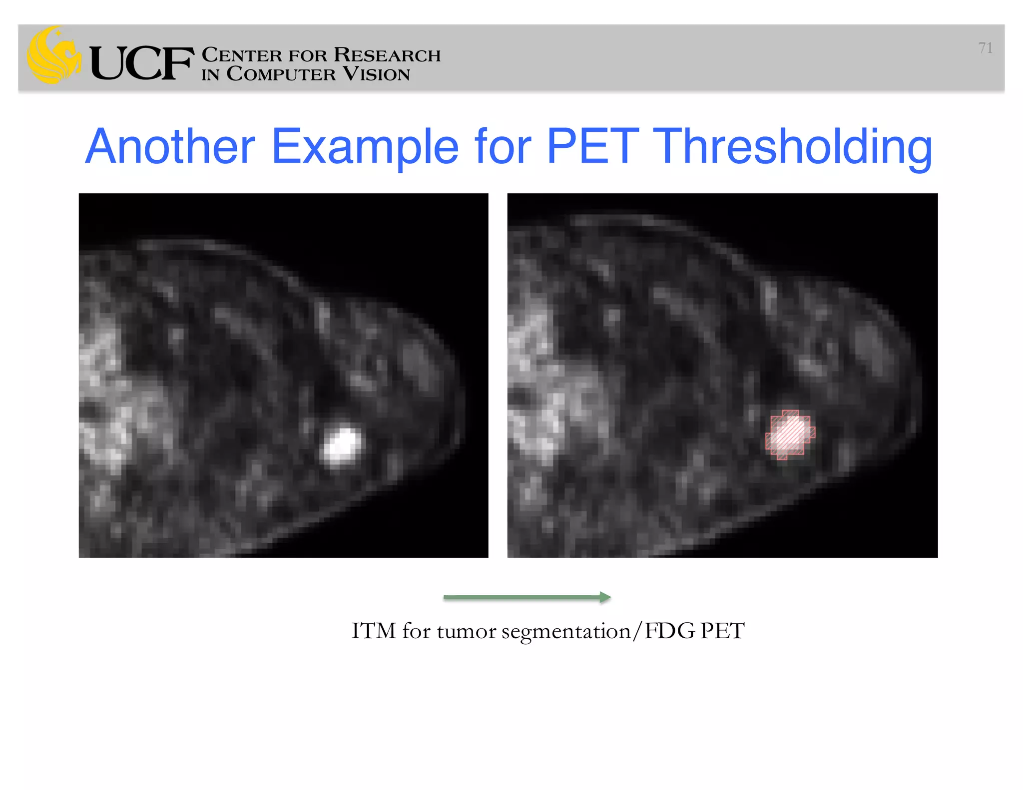 Another Example for PET Thresholding
71
ITM for tumor segmentation/FDG PET
 