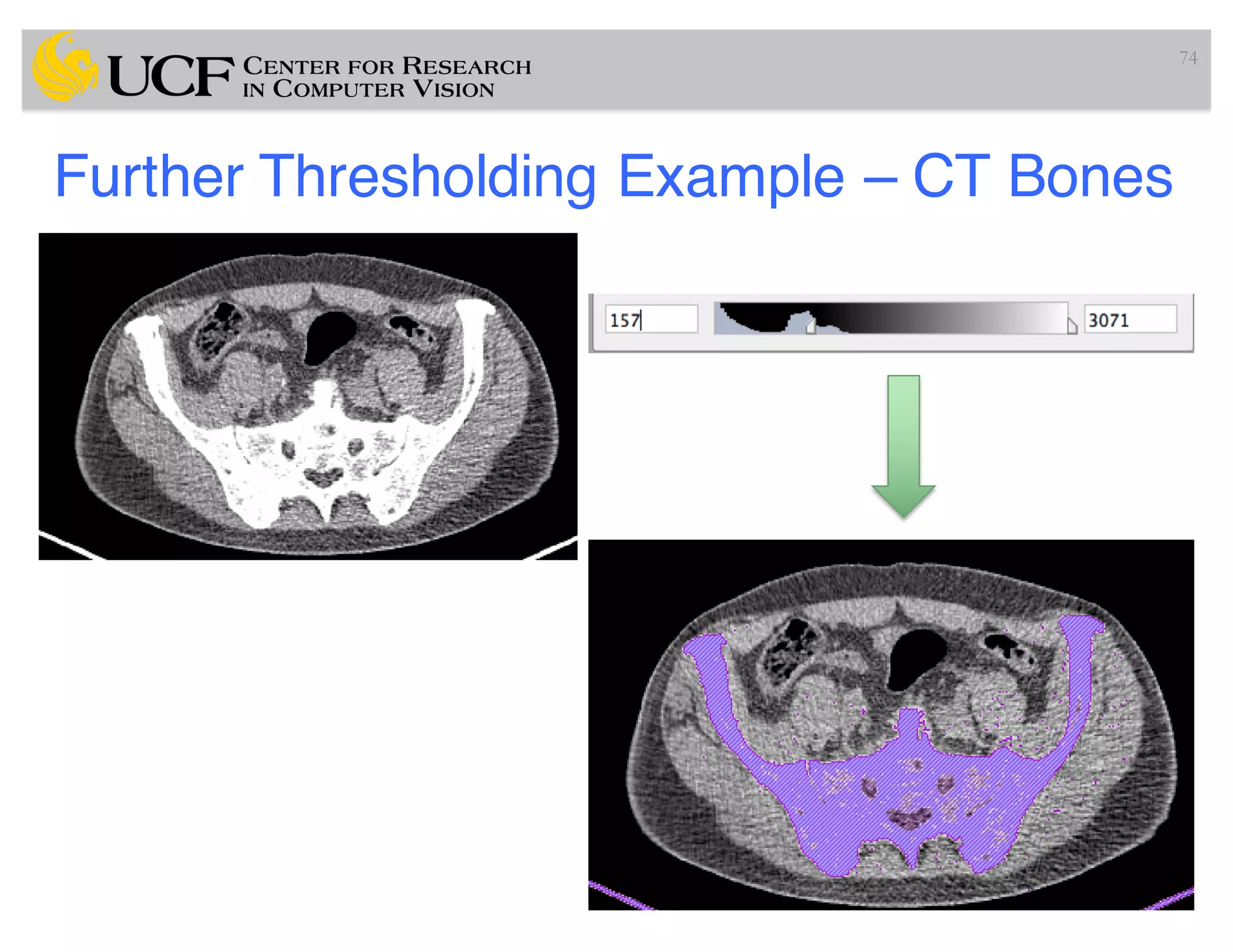Further Thresholding Example – CT Bones
74
 