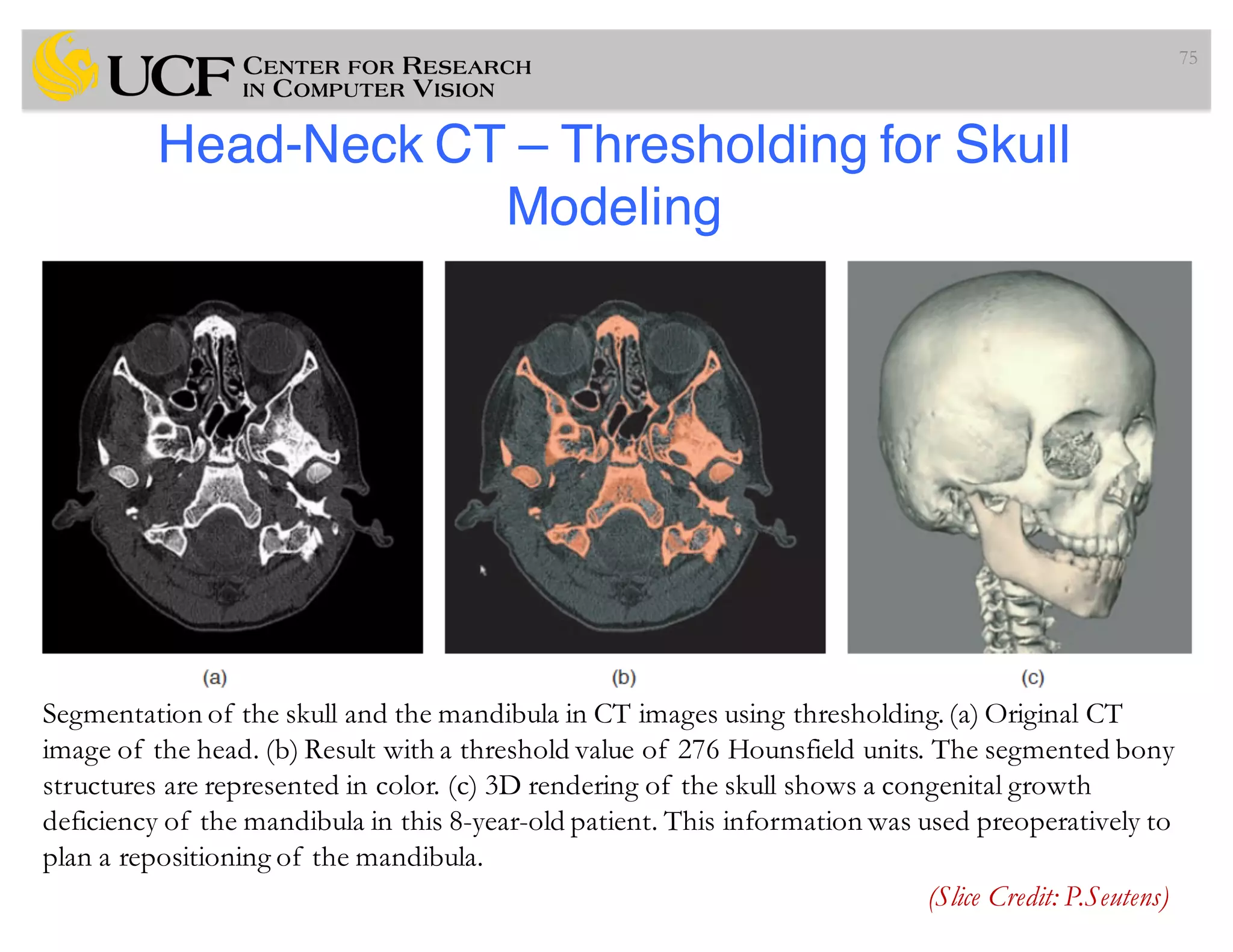 Head-Neck CT – Thresholding for Skull
Modeling
75
(Slice Credit: P.Seutens)
Segmentation of the skull and the mandibula in CT images using thresholding.(a) Original CT
image of the head. (b) Result with a threshold value of 276 Hounsfield units. The segmented bony
structures are represented in color. (c) 3D rendering of the skull shows a congenital growth
deficiency of the mandibula in this 8-year-old patient. This information was used preoperatively to
plan a repositioning of the mandibula.
 