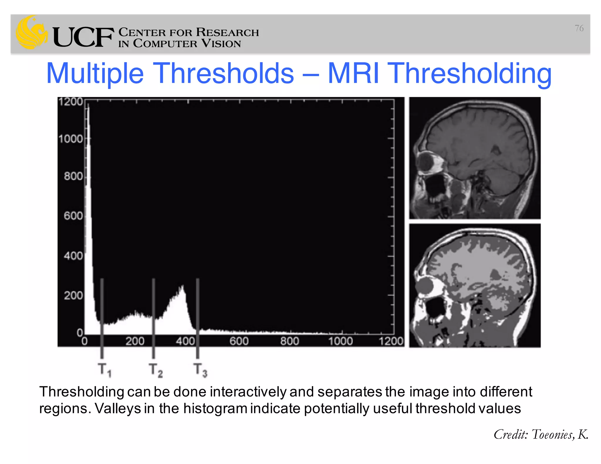Multiple Thresholds – MRI Thresholding
76
Thresholding can be done interactively and separates the image into different
regions. Valleys in the histogram indicate potentially useful threshold values
Credit: Toeonies,K.
 