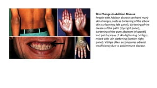 Skin Changes in Addison Disease
People with Addison disease can have many
skin changes, such as darkening of the elbow
skin surface (top left panel), darkening of the
creases of the palm (top right panel),
darkening of the gums (bottom left panel)
and patchy areas of skin lightening (vitiligo)
mixed with skin darkening (bottom right
panel). Vitiligo often accompanies adrenal
insufficiency due to autoimmune disease.
 