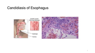 Lec 7 fungal infections | PPTX