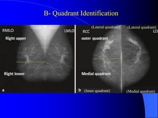 Quadrant Identifier Lec_7_How to read Mammography_7-5-25 (1).pdf