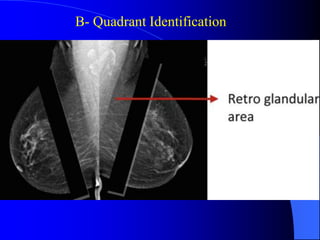 Quadrant Identifier Lec_7_How to read Mammography_7-5-25 (1).pdf