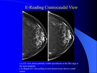 Lec_7_How to read Mammography_7-5-25 (1).pdf
