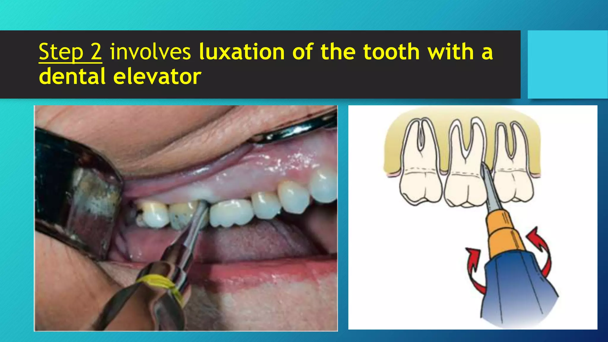 Mechanical Principles Involved in Tooth Extraction 1 PPT