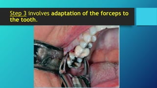 Mechanical Principles Involved in Tooth Extraction 1 | PPTX