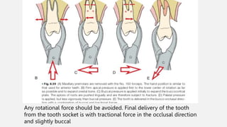 Mechanical Principles Involved in Tooth Extraction 2 | PPTX