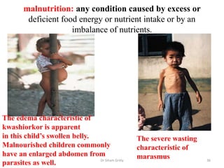 malnutrition: any condition caused by excess or
deficient food energy or nutrient intake or by an
imbalance of nutrients.
Dr Siham Gritly 36
The severe wasting
characteristic of
marasmus
The edema characteristic of
kwashiorkor is apparent
in this child’s swollen belly.
Malnourished children commonly
have an enlarged abdomen from
parasites as well.
 