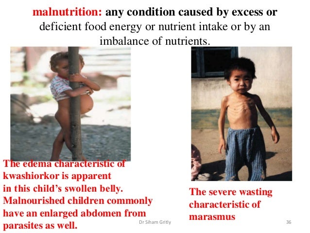 Why do malnourished children have bloated stomachs?