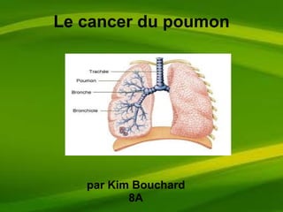 Le cancer du poumon par Kim Bouchard 8A 