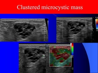 Lec_Breast Cystic lesion_USG_23-4-25.pdf