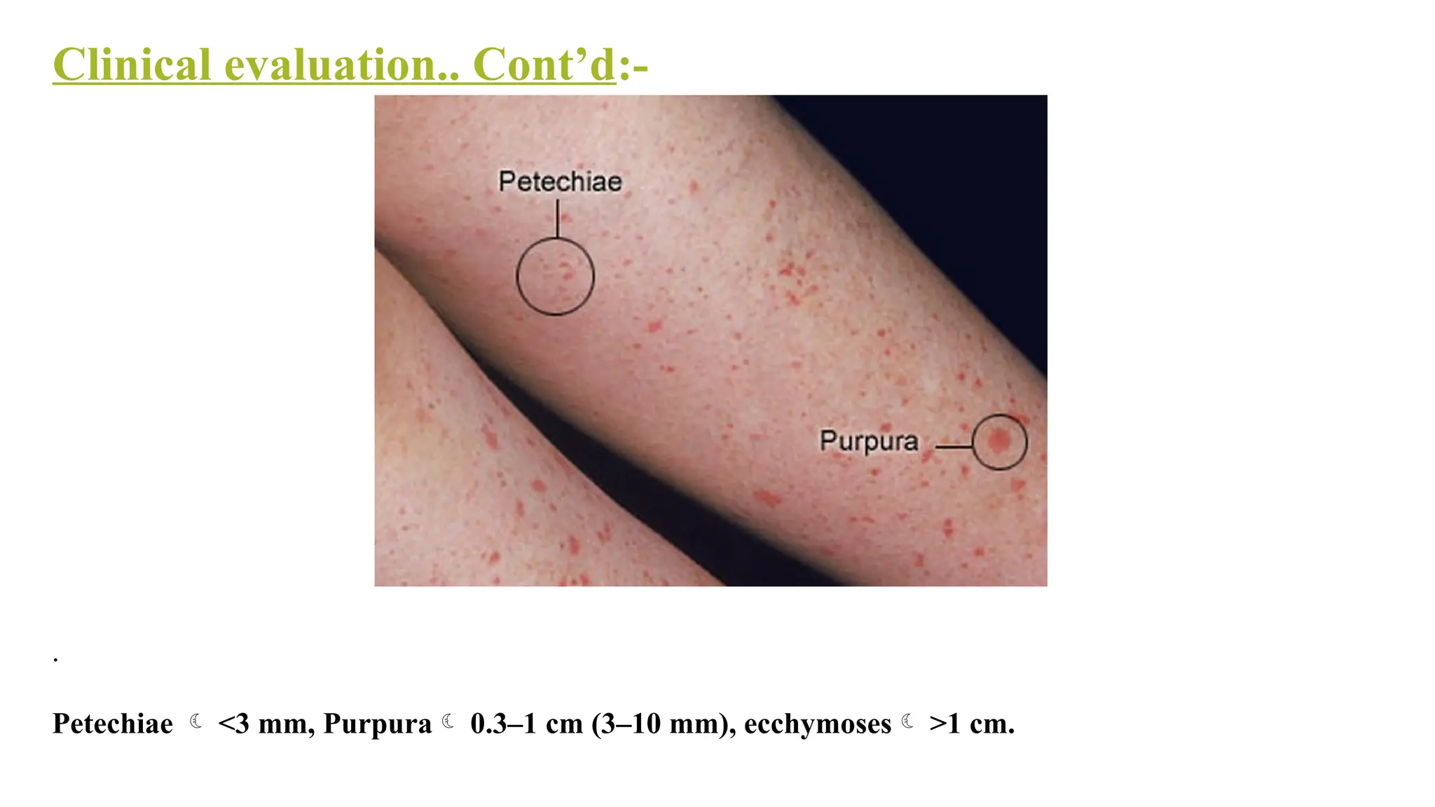 Clinical evaluation.. Cont’d:-
.
Petechiae  <3 mm, Purpura 0.3–1 cm (3–10 mm), ecchymoses >1 cm.
 
