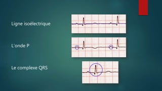 Ligne isoélectrique
L’onde P
Le complexe QRS
 