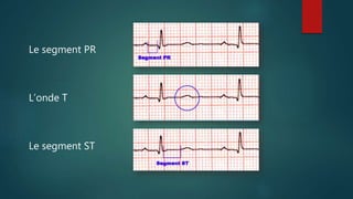 Le segment PR
L’onde T
Le segment ST
 