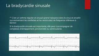 La bradycardie sinusale
°° C’est un rythme régulier et sinusal (prend naissance dans le sinus et envahit
successivement les oreillettes et les ventricules) de fréquence inférieure à
60/min
Si la bradycardie sinusale est importante, elle peut s'accompagner de
complexes d'échappement, jonctionnels ou ventriculaires
 