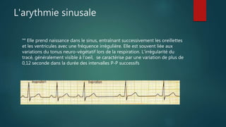 L'arythmie sinusale
°° Elle prend naissance dans le sinus, entraînant successivement les oreillettes
et les ventricules avec une fréquence irrégulière. Elle est souvent liée aux
variations du tonus neuro-végétatif lors de la respiration. L'irrégularité du
tracé, généralement visible à l’oeil, se caractérise par une variation de plus de
0,12 seconde dans la durée des intervalles P-P successifs
 