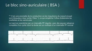 Le bloc sino-auriculaire ( BSA )
°° C’est une anomalie de la conduction où les impulsions du noeud sinusal
sont bloquées à leur sortie ("bloc "), ce qui empêche l’influx d’atteindre les
oreillettes et les ventricules
Le tracé se caractérise par un intervalle PP régulier, avec des pauses (absence
complète d’un cycle) dont la durée est un multiple d’un intervalle PP normal
 