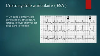 L’extrasystole auriculaire ( ESA )
°° On parle d’extrasystole
auriculaire ou atriale (ESA)
lorsque le foyer anormal est
situé dans l'oreillette
 