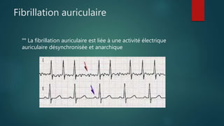 Fibrillation auriculaire
°° La fibrillation auriculaire est liée à une activité électrique
auriculaire désynchronisée et anarchique
 