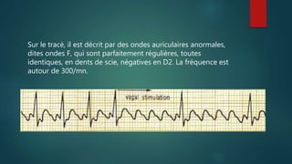 Sur le tracé, il est décrit par des ondes auriculaires anormales,
dites ondes F, qui sont parfaitement régulières, toutes
identiques, en dents de scie, négatives en D2. La fréquence est
autour de 300/mn.
 
