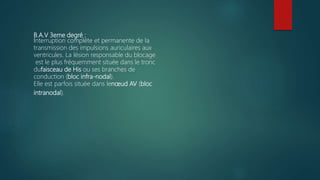 B.A.V 3eme degré :
Interruption complète et permanente de la
transmission des impulsions auriculaires aux
ventricules. La lésion responsable du blocage
est le plus fréquemment située dans le tronc
dufaisceau de His ou ses branches de
conduction (bloc infra-nodal).
Elle est parfois située dans lenœud AV (bloc
intranodal).
 
