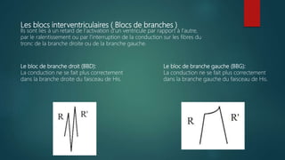 Les blocs interventriculaires ( Blocs de branches )
Ils sont liés à un retard de l'activation d'un ventricule par rapport à l'autre,
par le ralentissement ou par l'interruption de la conduction sur les fibres du
tronc de la branche droite ou de la branche gauche.
Le bloc de branche droit (BBD):
La conduction ne se fait plus correctement
dans la branche droite du faisceau de His.
Le bloc de branche gauche (BBG):
La conduction ne se fait plus correctement
dans la branche gauche du faisceau de His.
 