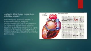 La séquelle d’infarctus du myocarde, ou
onde Q de nécrose :
Elle correspond anatomiquement à la
du tissu myocardique, remplacé
progressivement par une cicatrice fibreuse.
Elle représente la perte totale d’activité
électrique du territoire concerné. Ces signes
électriques de nécrose peuvent affirmer la
nécrose anatomique, séquelle d'un infarctus
de myocarde.
 