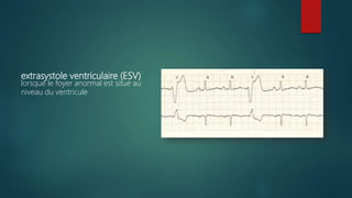 extrasystole ventriculaire (ESV)
lorsque le foyer anormal est situé au
niveau du ventricule
 