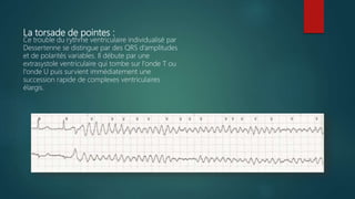 La torsade de pointes :
Ce trouble du rythme ventriculaire individualisé par
Dessertenne se distingue par des QRS d’amplitudes
et de polarités variables. Il débute par une
extrasystole ventriculaire qui tombe sur l'onde T ou
l'onde U puis survient immédiatement une
succession rapide de complexes ventriculaires
élargis.
 
