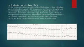 La fibrillation ventriculaire ( FV )
C’est une désorganisation complète de l’activité électrique et donc mécanique
des ventricules. L’extrasystole est le catalyseur ou le mécanisme précipitant, car
son impulsion peut envahir les ventricules avec asymétrie des périodes
réfractaires; il pourra alors y avoir décharges de multiples foyers ectopiques.
prédisposition la plus importante est l’altération ventriculaire, notamment pour
des raisons d’ischémie Les QRS sont très anormaux, méconnaissables,
des uns aux autres, tant en amplitude, qu’en durée, ou en fréquence.
 