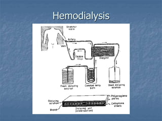 Hemodialysis
 