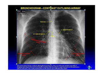 Comprehensive Guide to Chest X-Ray Interpretation and Anatomy | PDF