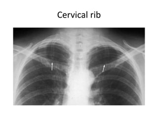 Comprehensive Guide to Chest X-Ray Interpretation and Anatomy | PDF