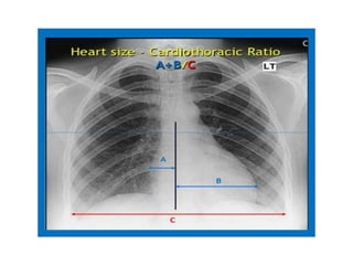 Comprehensive Guide to Chest X-Ray Interpretation and Anatomy | PDF