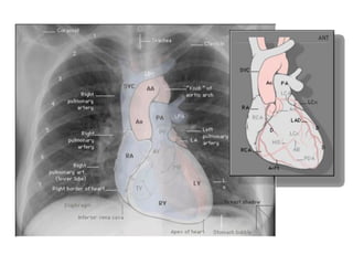 Comprehensive Guide to Chest X-Ray Interpretation and Anatomy | PDF