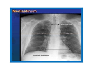 Comprehensive Guide to Chest X-Ray Interpretation and Anatomy | PDF