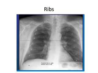 Comprehensive Guide to Chest X-Ray Interpretation and Anatomy | PDF