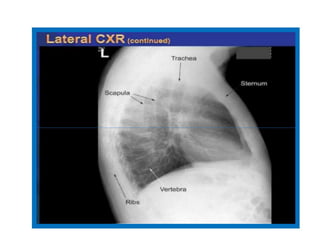 Sternum Rx Comprehensive Guide to Chest X-Ray Interpretation and Anatomy | PDF