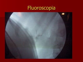 Fluoroscopia Maior familiaridade Detalhes anatômicos após o contraste Exposição à radiação Custos Necessidade de contraste para os  radio-transparentes 
