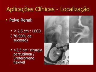 Aplicações Clínicas - Localização Pelve Renal: < 2,5 cm : LECO  ( 70-90% de sucesso) >2,5 cm: cirurgia percutânea / ureterorreno flexível 