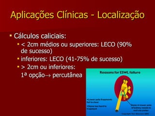 Aplicações Clínicas - Localização Cálculos caliciais: < 2cm médios ou superiores: LECO (90% de sucesso) inferiores: LECO (41-75% de sucesso) > 2cm ou inferiores:  1ª opção   percutânea  